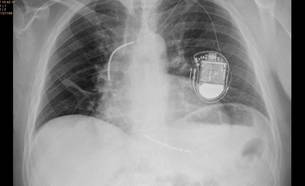 Implante y seguimiento de dispositivos (Asistencia > Electrofisiología y Estimulación Cardiaca > Qué hacemos) | iCor | Institut del Cor del germans Trias i Pujol