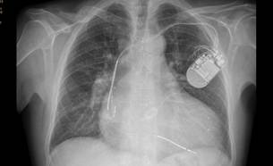 Implante y seguimiento de dispositivos (Asistencia > Electrofisiología y Estimulación Cardiaca > Qué hacemos) | iCor | Institut del Cor del germans Trias i Pujol